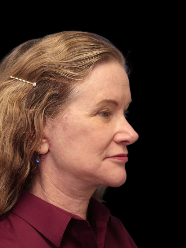 Blepharoplasty Before & After