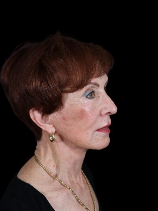 Blepharoplasty Before & After