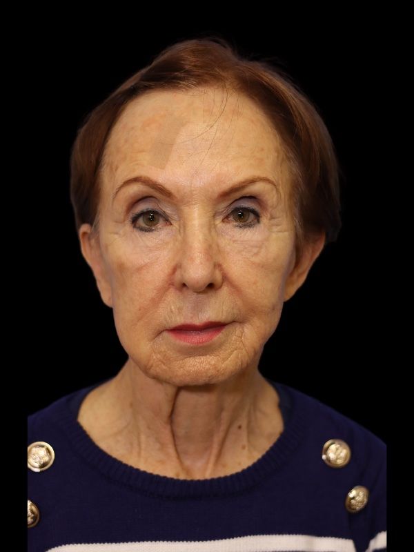 Blepharoplasty Before & After