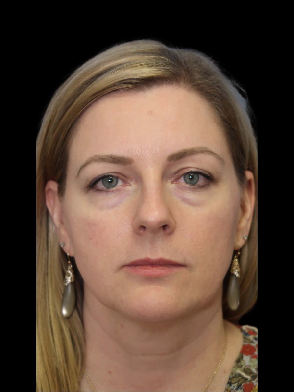 Blepharoplasty Before & After