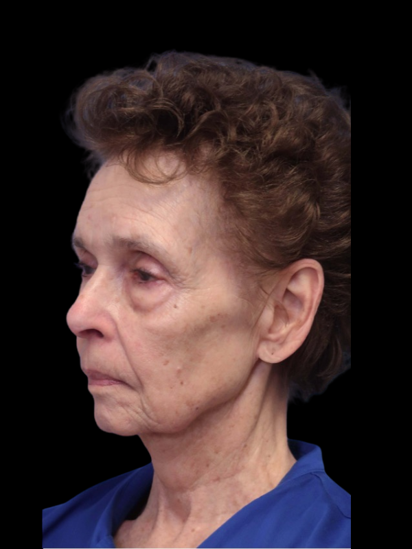 Blepharoplasty Before & After