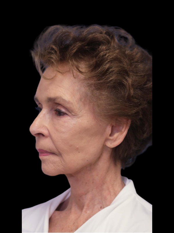 Blepharoplasty Before & After