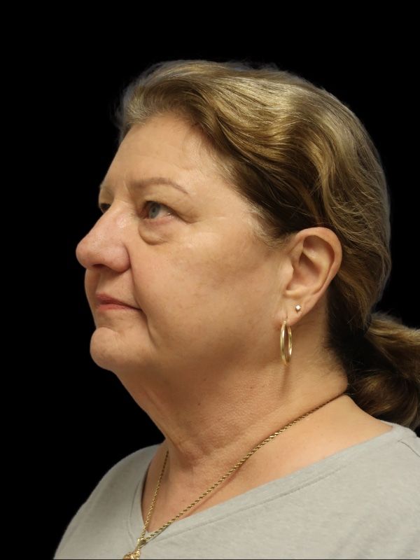 Blepharoplasty Before & After