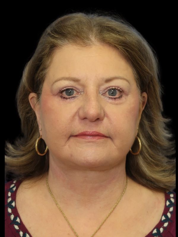 Blepharoplasty Before & After