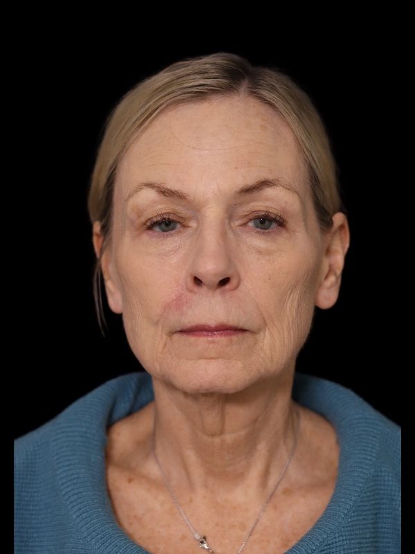 Blepharoplasty Before & After