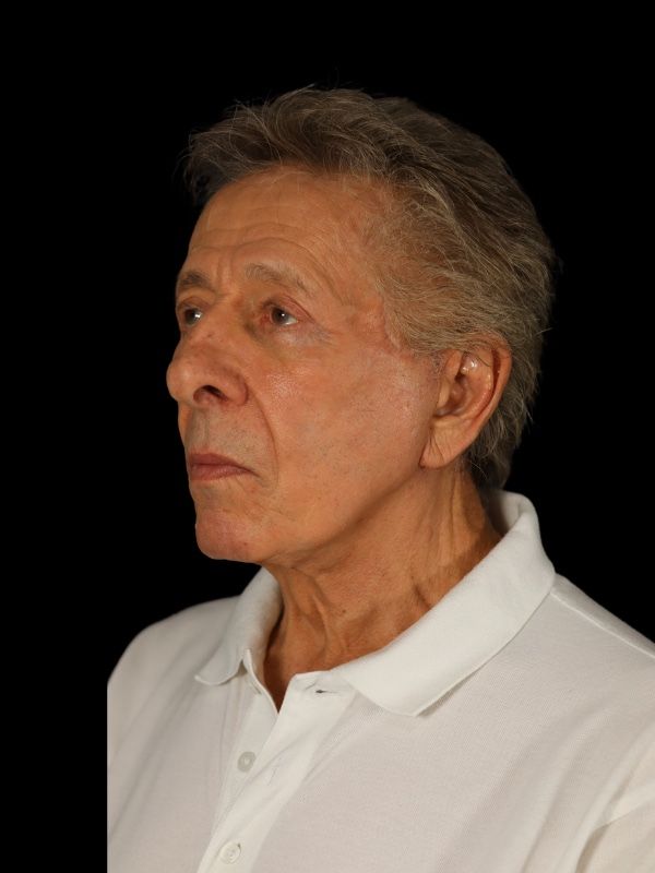 Blepharoplasty Before & After