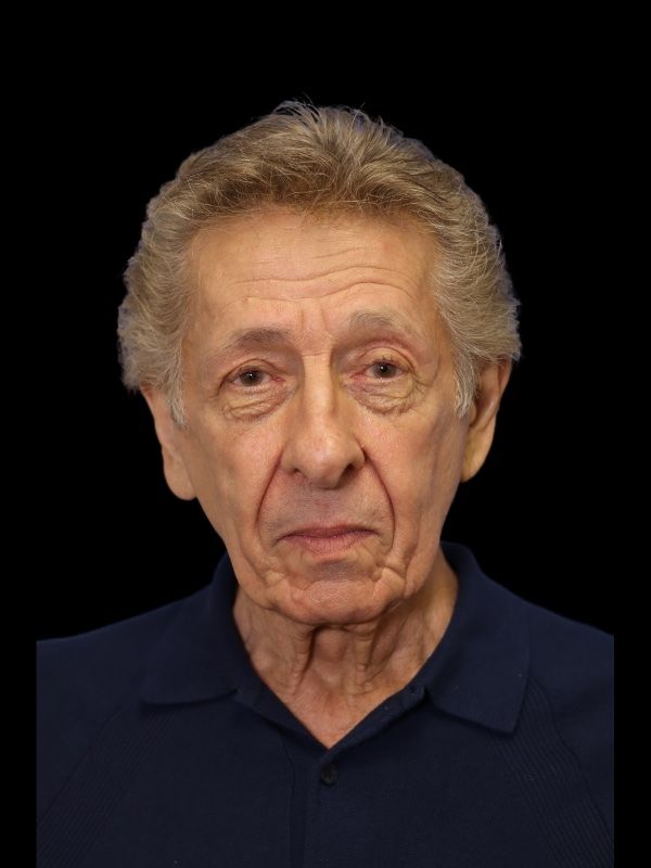 Blepharoplasty Before & After