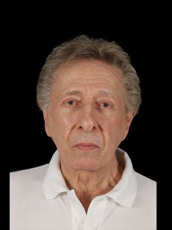 Blepharoplasty Before & After