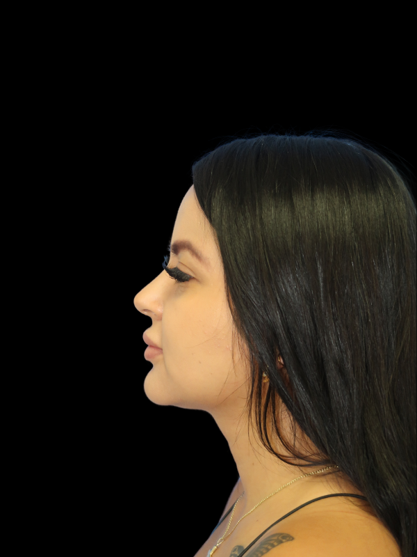 Facetite Before & After