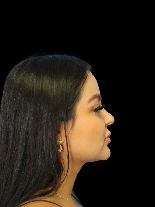 Facetite Before & After