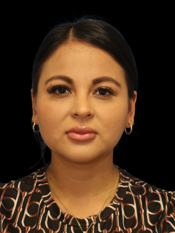 Facetite Before & After