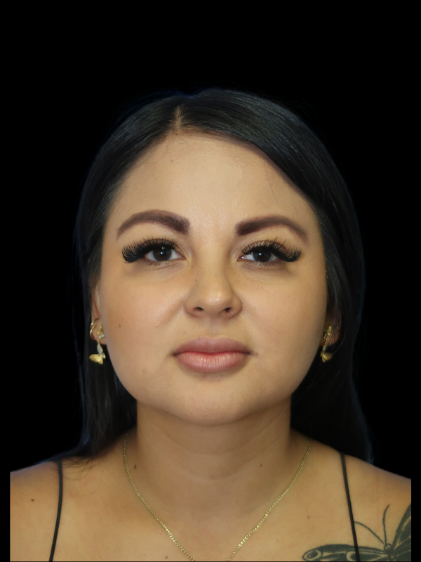 Facetite Before & After