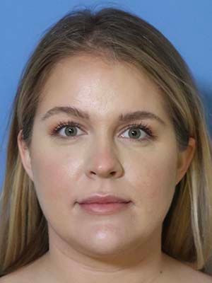 Facetite Before & After