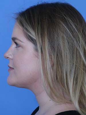 Facetite Before & After