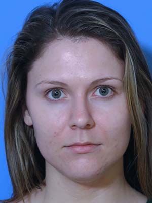 Facetite Before & After