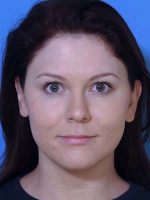 Facetite Before & After