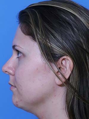 Facetite Before & After