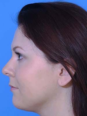 Facetite Before & After