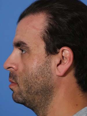 Facetite Before & After