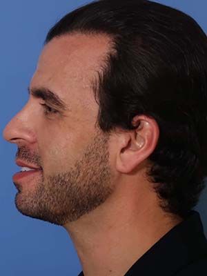 Facetite Before & After