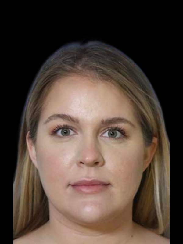 Facetite Before & After