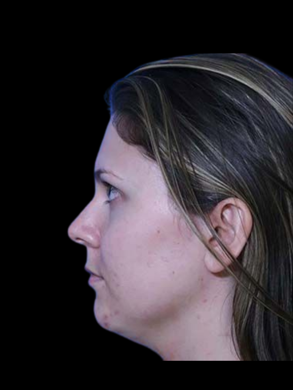 Facetite Before & After