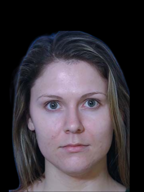 Facetite Before & After