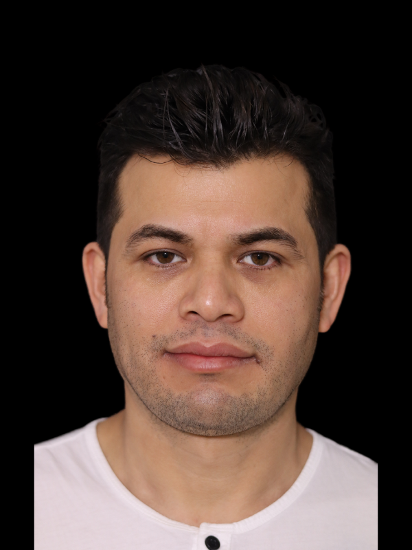 Facetite Before & After