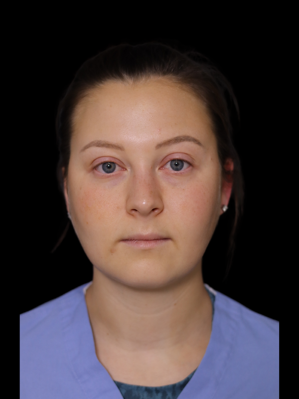 Facetite Before & After