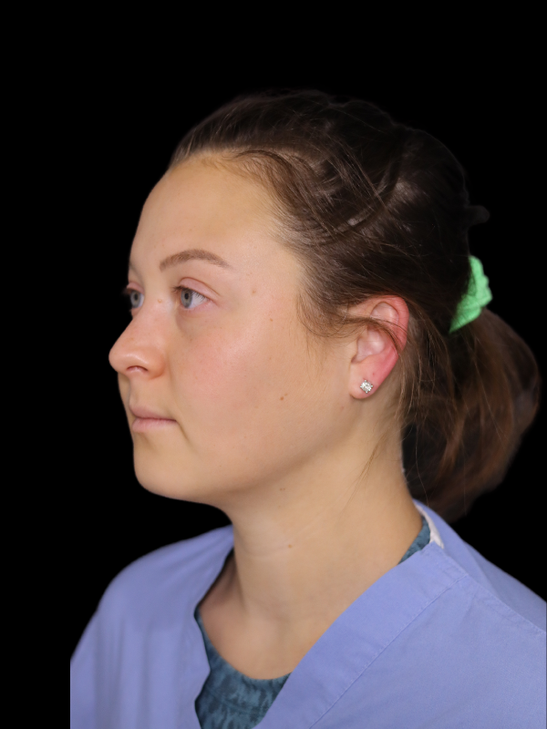 Facetite Before & After