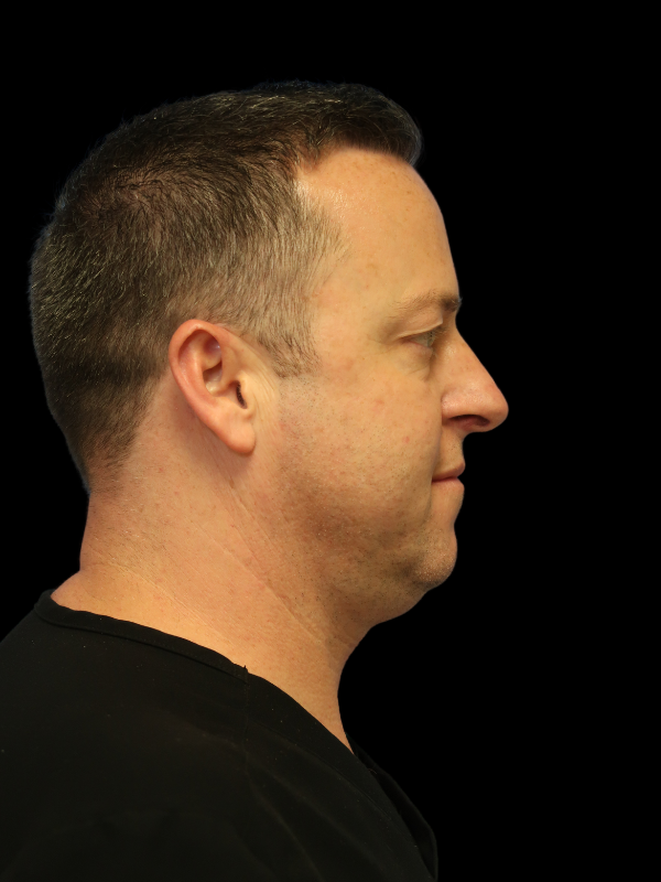 Facetite Before & After