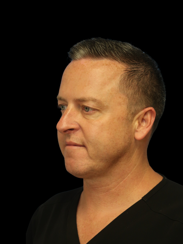 Facetite Before & After