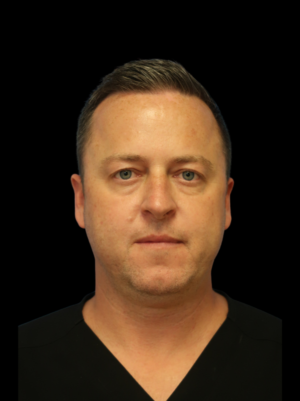 Facetite Before & After