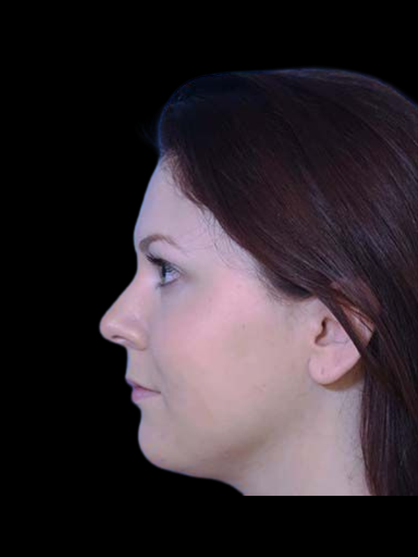 Facetite Before & After