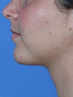 Acne Scarring Before & After
