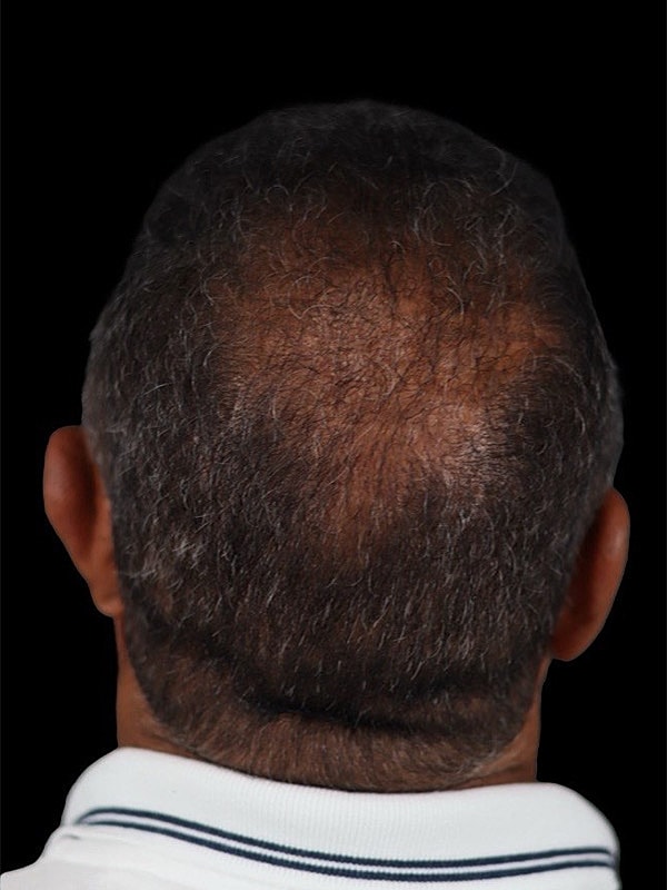 Hair Loss Restoration Before & After