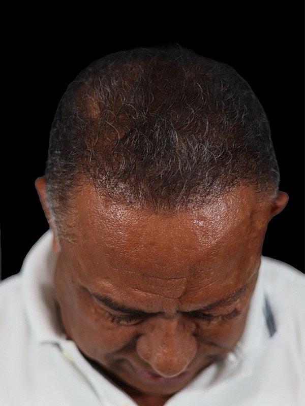 Hair Loss Restoration Before & After