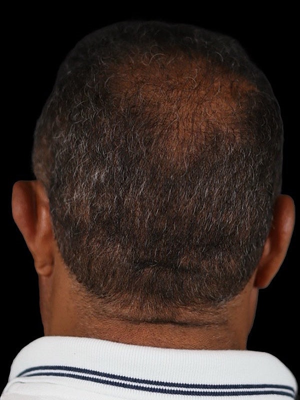 Hair Loss Restoration Before & After