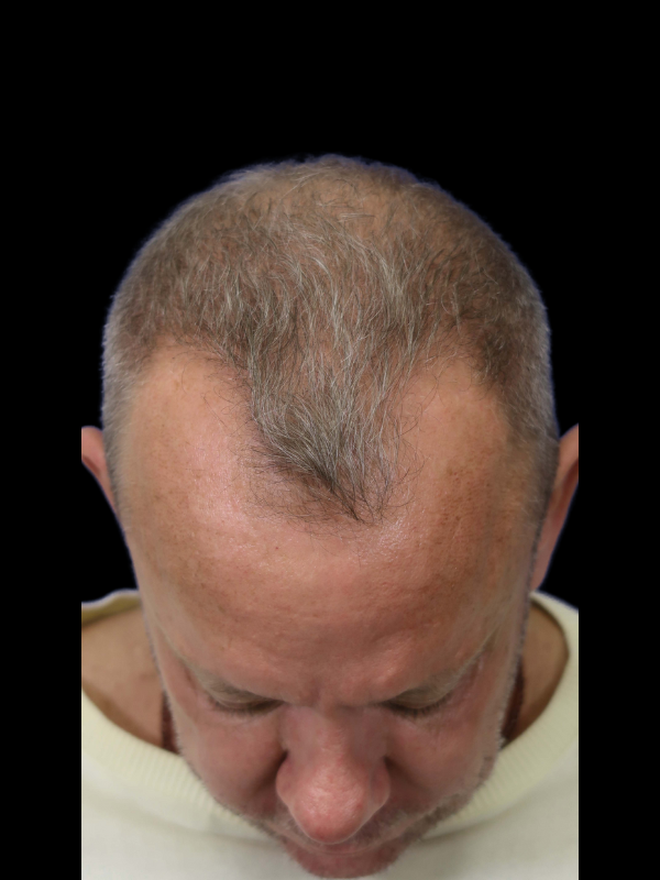 Hair Loss Restoration Before & After