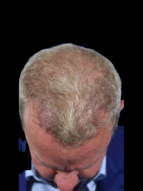 Hair Loss Restoration Before & After