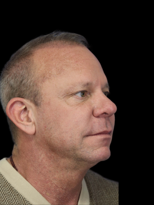 Hair Loss Restoration Before & After