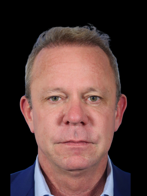 Hair Loss Restoration Before & After