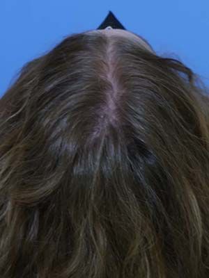 Hair Loss Restoration Before & After