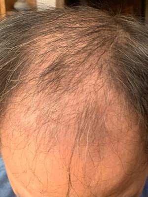 Hair Loss Restoration Before & After