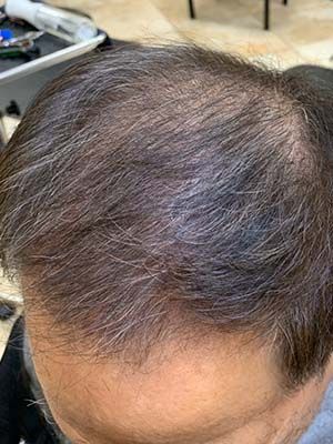 Hair Loss Restoration Before & After