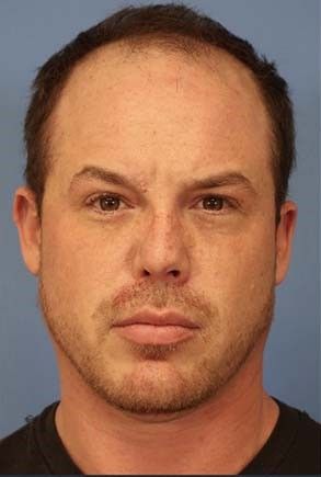 Hair Loss Restoration Before & After