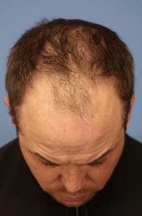 Hair Loss Restoration Before & After