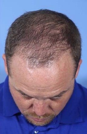 Hair Loss Restoration Before & After