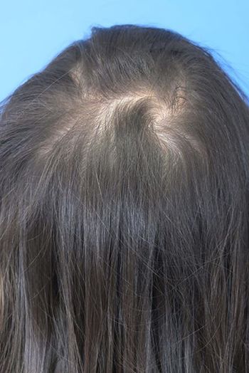 Hair Loss Restoration Before & After