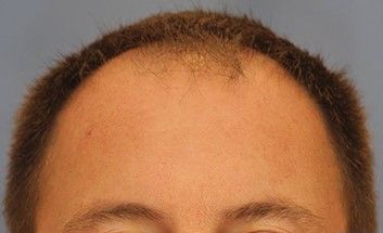 Hair Loss Restoration Before & After